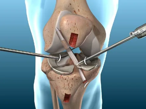 ACL and PCL ligament reconstruction surgery in Guntur