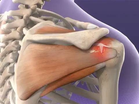 Shoulder and rotator cuff repair treatment in Guntur